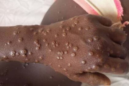 Mpox